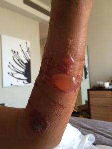 Blisters immediately after surgery 