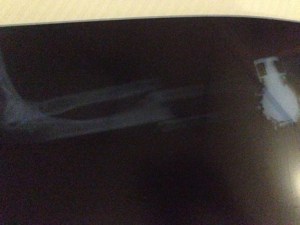 X-ray of broken Arm: Pre-Surgery 