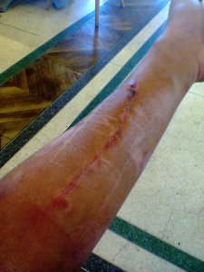 6 weeks after surgery. Cast off, and scars are healing but very little feeling in fingers. 