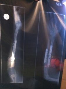 Post Surgery: Thanks to Helen Joseph Hospital 